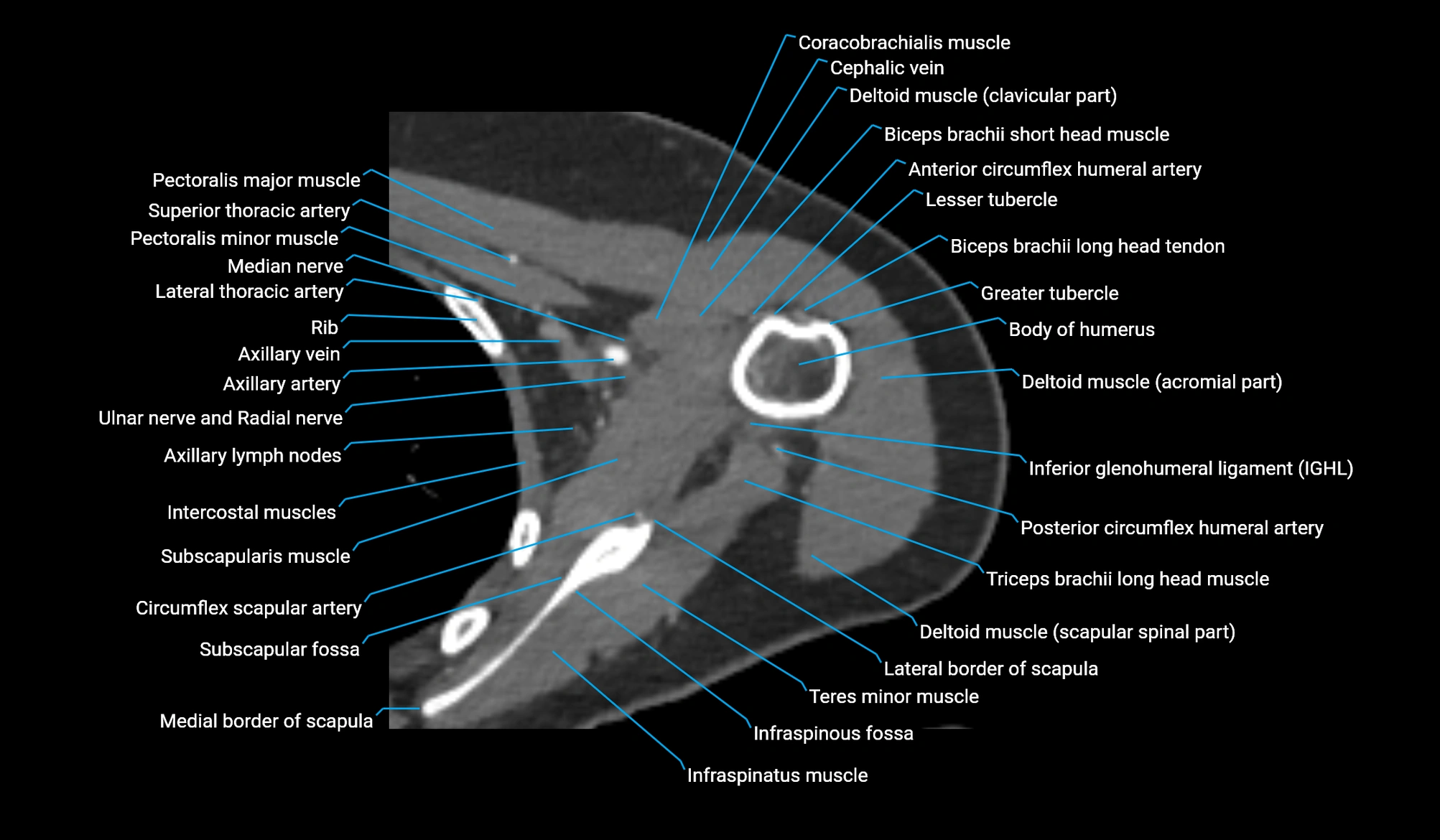 CT upper arm axial  cross sectional anatomy labelled radiology image -00120.webp